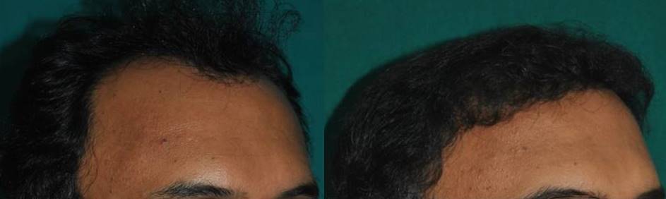 Hair transplant result Kerala, India